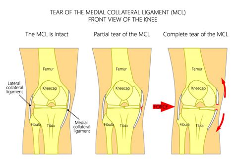 Knee Surgery Survival Knowledge - MCL Injuries Surgeries