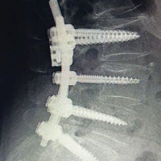 Post Operative Lateral View X Ray Illustrating Successful L L