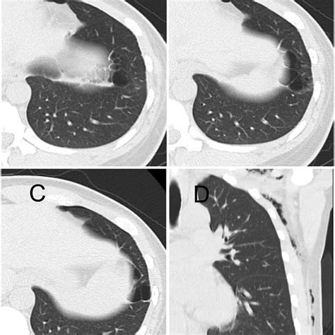 Chest Computed Tomography Scans The Axial Views A B C And A