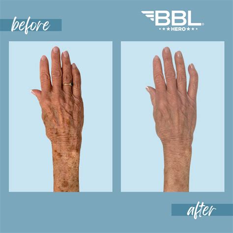 Sciton BBL Treatment Denver | Denver BBL laser treatment