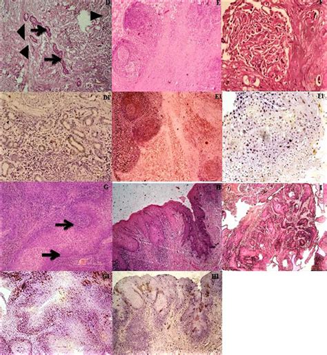 Histological And Immunohistochemical Characterization Of Variants D