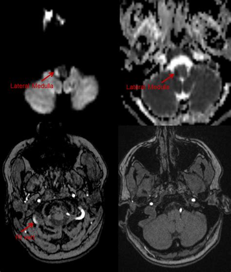 Pica syndrome stroke - mongset