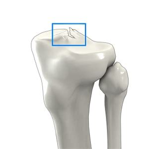 Tibial Eminence Spine Avulsion Fracture Kansas City | Knee Fracture Lee ...