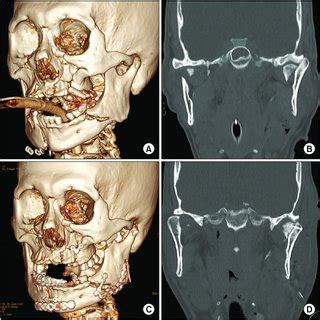 A. Le Fort II fracture and mandibular symphysis fracture. B ...