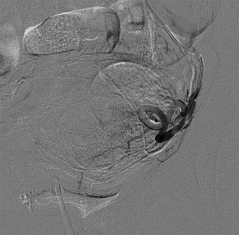 Fibroma Uterino Caso Clinico 8 Interventix