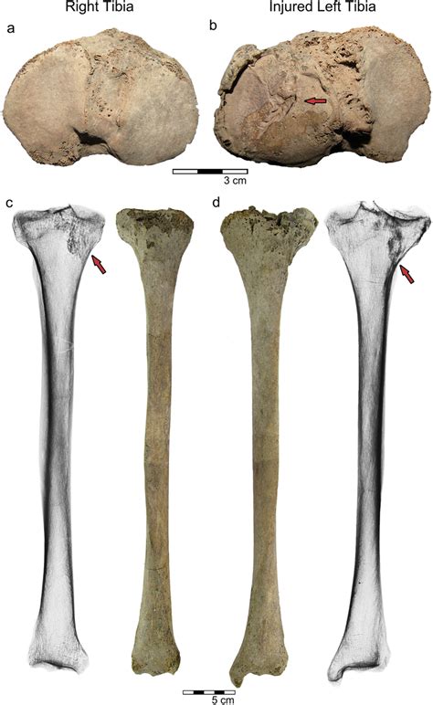 Comparison between the right tibia (left column) and the left tibia ...