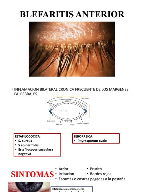 Blefaritis Anterior Pdf