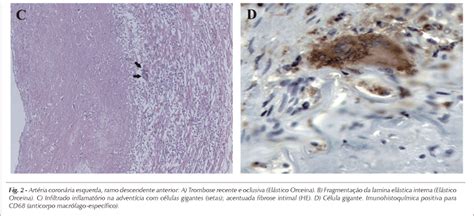 SciELO Brasil Arterite de células gigantes coronariana e infarto