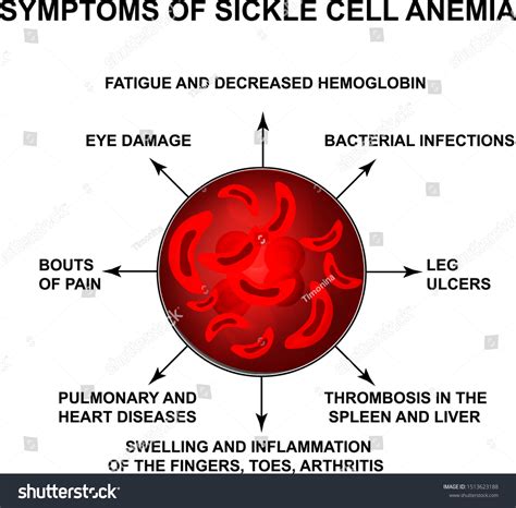 Symptoms Sickle Cell Anemia World Sickle Stock Vector Royalty Free