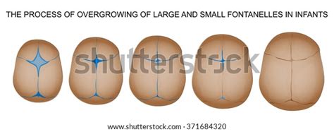 Closure Fontanel Newborn Stock Vector (Royalty Free) 371684320