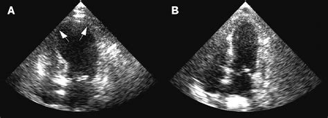 Takotsubo Cardiomyopathy Broken Heart Syndrome Stress Induced