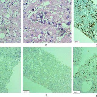 Histological And Immunohistochemical Features Of Intravascular Large B