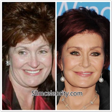 Sharon Osbourne Plastic Surgery Before and after Photos Face Lift ...