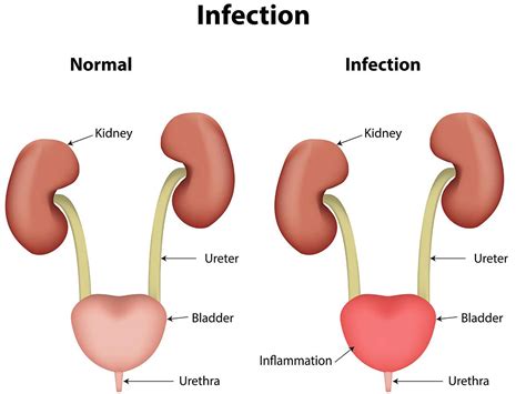 Urinary Tract Infections UTI Melbourne North Eastern Urology