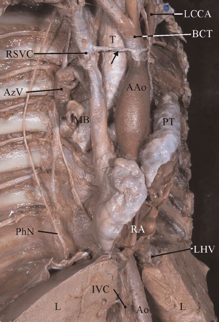 Anatomical Specimen Showing Right Rsvc And Left Superior Vena Cava