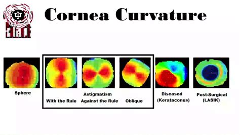 Normal Corneal Topography