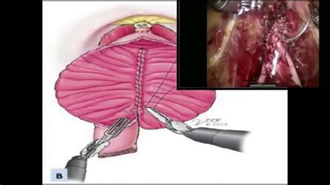 Robotic Assisted Radical Cystectomy With Intracorporeal Neobladder