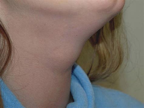 Thyroid Symptoms in Women - Thyroid Clinic Sydney