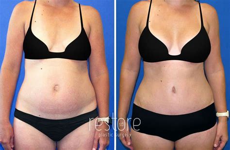 Mommy Makeover San Diego Procedure Info Scars Reviews Results