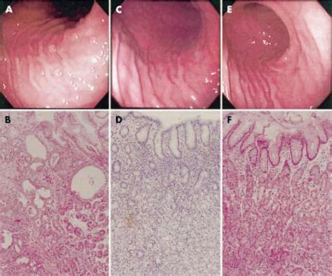 Endoscopic And Microscopic Findings In Patient No Ii Multiple Sessile Download Scientific