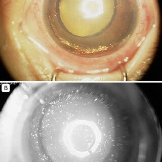 A Clinical Photograph Of The Left Eye Anterior Segment Showing