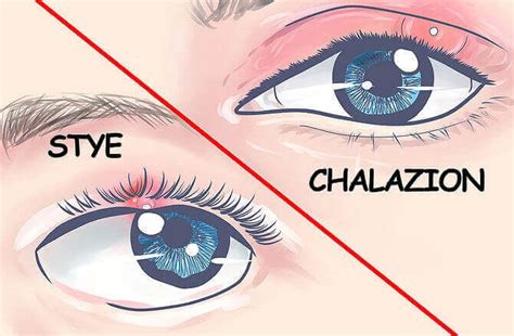 Chalazion VS Stye: How Chalazion Is Different From Stye - Health Blog