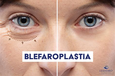 Blefaroplastia Guia Saúde Cidades