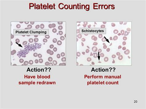 Total Platelet Count Using Hemocytometer Hematology 50 Off