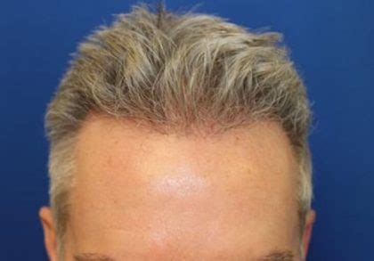 Patient Hair Restoration Before And After Photos La Jolla