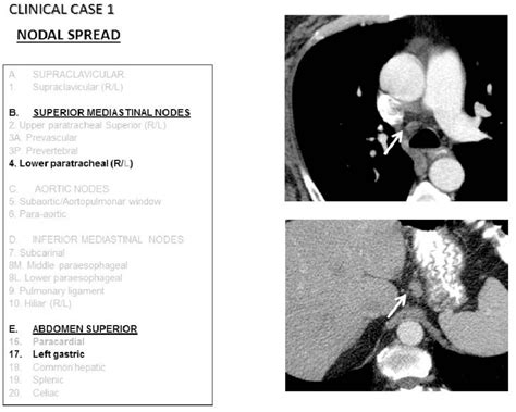 Figure 1 From Esophageal Cancer Anatomical Features Current