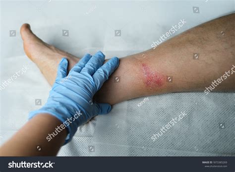 Doctor Treats Large Healing Wound Severe Stock Photo 1873385269