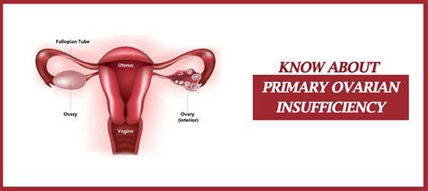 Primary Ovarian Insufficiency Causes Symptoms And Management