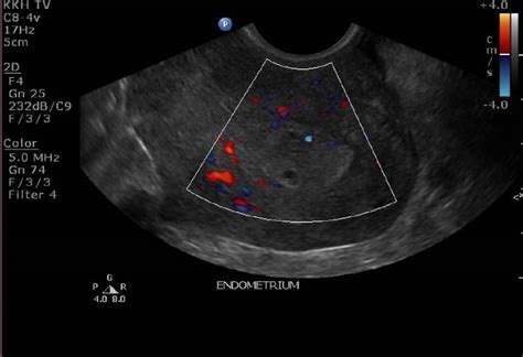 Cystic Endometrial Hyperplasia Ultrasound