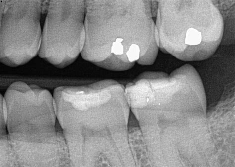 Instant and Accurate Detection of Early Occlusal Caries | Dental Jay