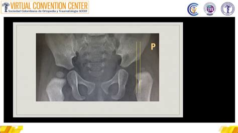 Displasia Cong Nita De Cadera