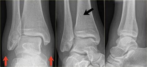 Normal Pediatric Ankle Xray