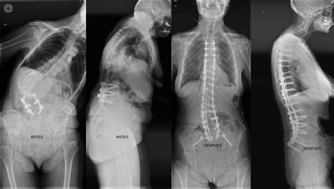 Cirugía Reconstructiva Vertebral Cirugia de columna