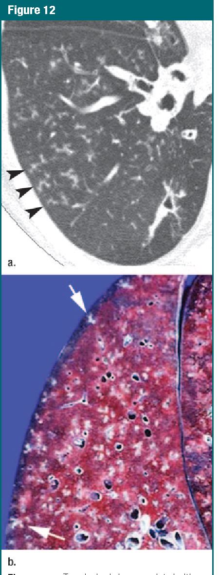 Figure 12 from Thin-section CT of the secondary pulmonary lobule ...