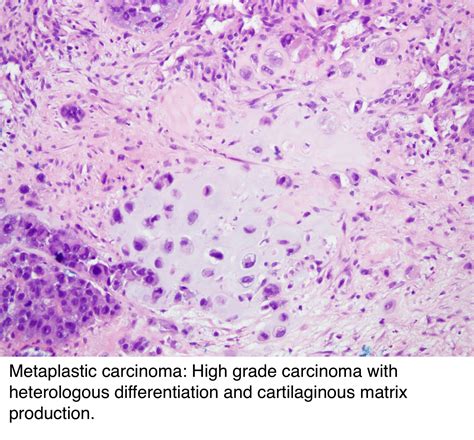 Pathology Outlines Who Classification