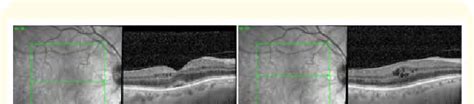 OCT of the right eye (case 2). | Download Scientific Diagram