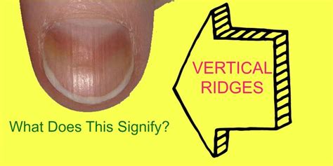 Vertical Nail Ridges On Fingernails Please Continue Read Vertical