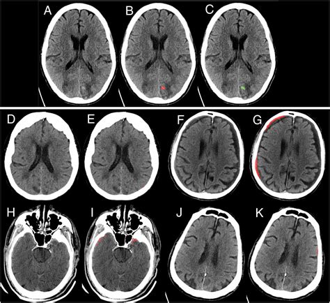 Expert Level Detection Of Acute Intracranial Hemorrhage On Head