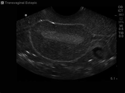 Ectopic Pregnancy Transvaginal Ultrasound Training Model Bpo