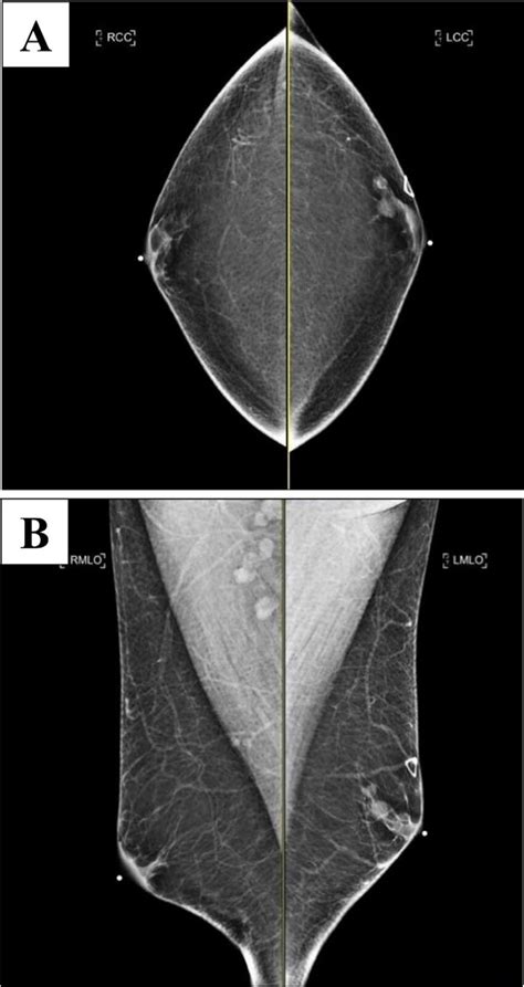 Bilateral Craniocaudal A And Mediolateral Oblique B Mammograms