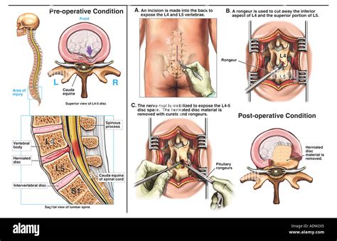 Discectomy Stock Photos Discectomy Stock Images Alamy