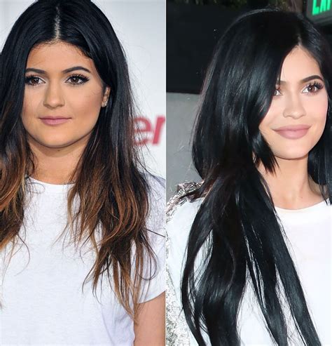 Kylie Jenner Talks Plastic Surgery On Her Face And Insecurities