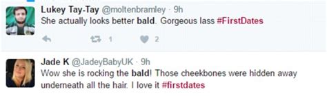 First Dates Alopecia Sufferer Praised For Her Bravery Daily Mail Online