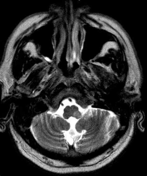 Lateral Pontine Syndrome Mri