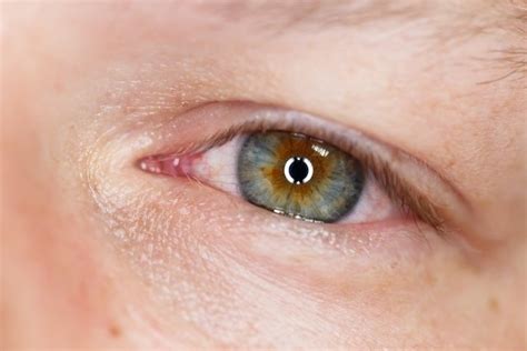 Coceira nos olhos 6 principais causas e o que fazer Tua Saúde