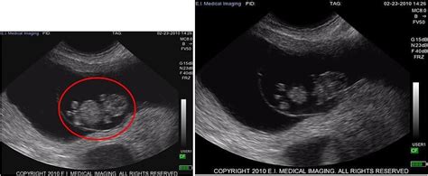 Ibex® Ultrasound Stages Of Early Bovine Pregnancy